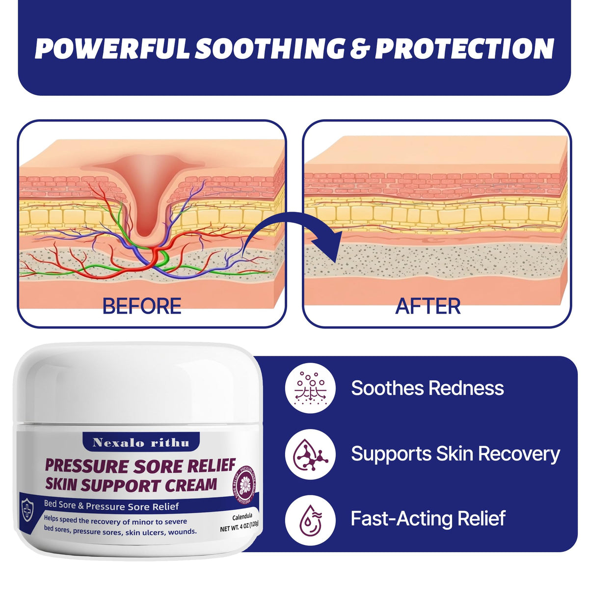 Calendula Aloe Vera Bed Sore Cream U388